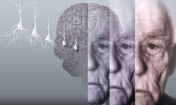 Çin'de 19 yaşındaki bir çocuğa Alzheimer hastalığı teşhisi koydular