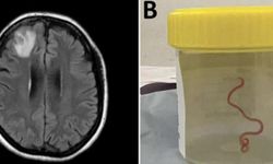 Dünyada bir ilk: Kadının beyninden canlı solucan çıkarıldı
