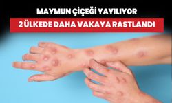 Maymun çiçeği yayılıyor! 2 ülkede daha vakaya rastlandı