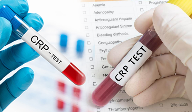 CRP türbidimetrik nedir? CRP yüksekliği ne anlama gelir?