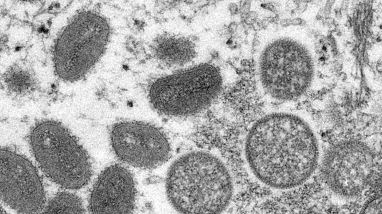 İtalya'da ilk maymun çiçeği virüsü vakası tespit edildi